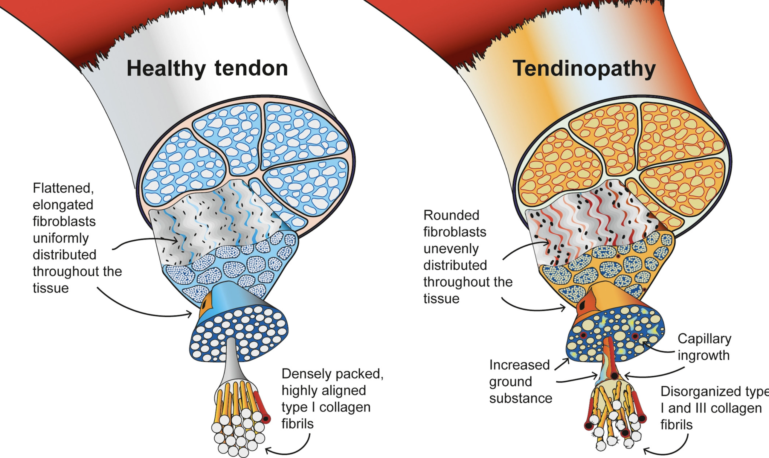 Tendinopathy vs Healthy Tendon
